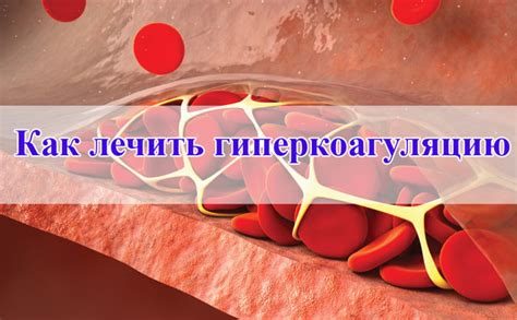 Гиперкоагуляция и тромбоэмболическая профилактика