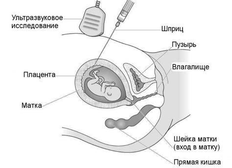 Гипоплазия ворсин хориона: