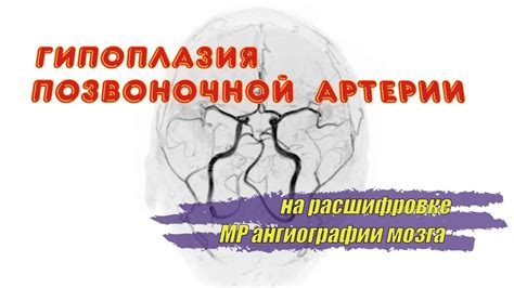 Гипоплазия левого синуса: симптомы и диагностика