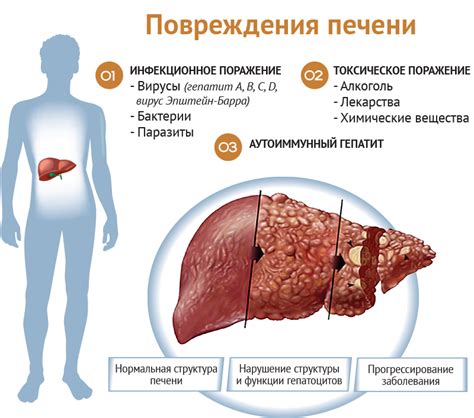 Лекарственное лечение гиповаскулярного очага в печени