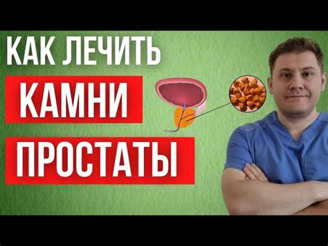 Лечение петрификатов на предстательной железе