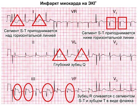 Нижний инфаркт неопределенной давности на ЭКГ - причины и симптомы