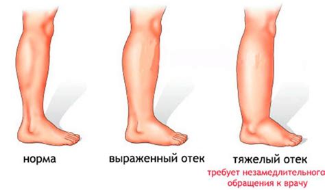 Основные симптомы и последствия натирания ноги от гипса