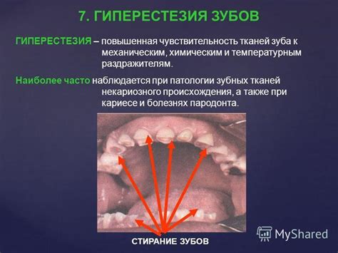 Повышенная чувствительность к температурным изменениям