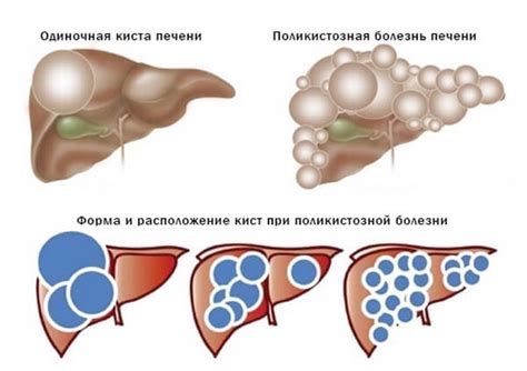 Причины возникновения гиподенсного образования в печени