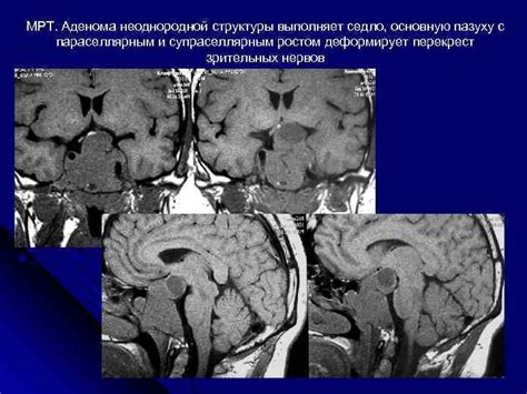 Профилактика неоднородной структуры гипофиза