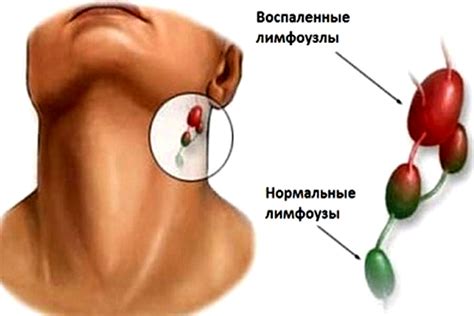 Симптомы внутрилегочных лимфоузлов